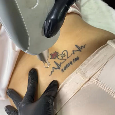 Desvaneciendo el Pasado: Remoción de Pigmento y Tatuajes con Láser